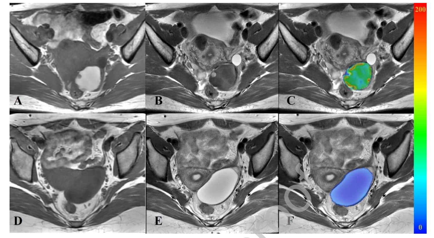 Graphical Abstract MRI R2*値による卵巣子宮内膜症の鉄沈着評価は卵巣機能を予測する